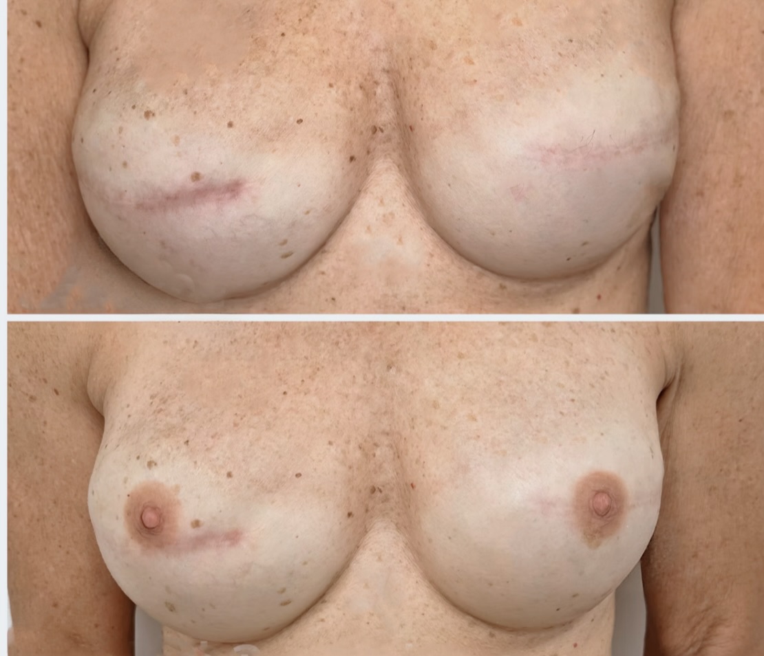 Scar camouflage restoration result